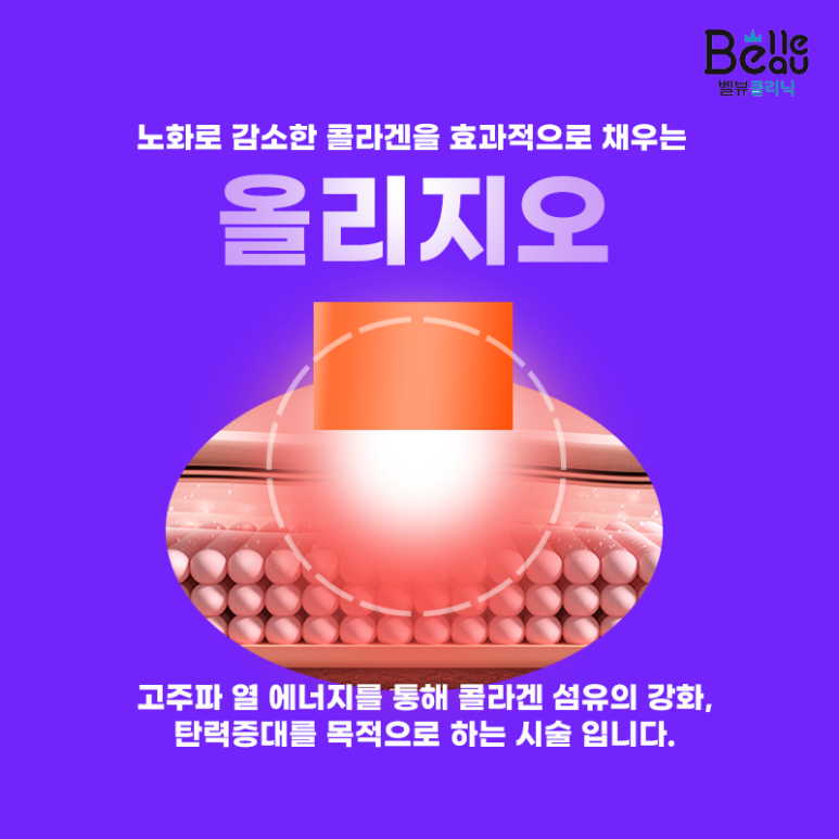 올리지오 리프팅 효과, 시술주기, 필요샷수 모두 알려드려요 관련 이미지 3