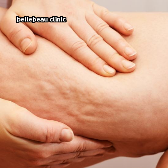The Key to Removing Midlife Belly Fat Is Breaking the Link Between [Skin Aging - Cellulite Accumulation] image 3