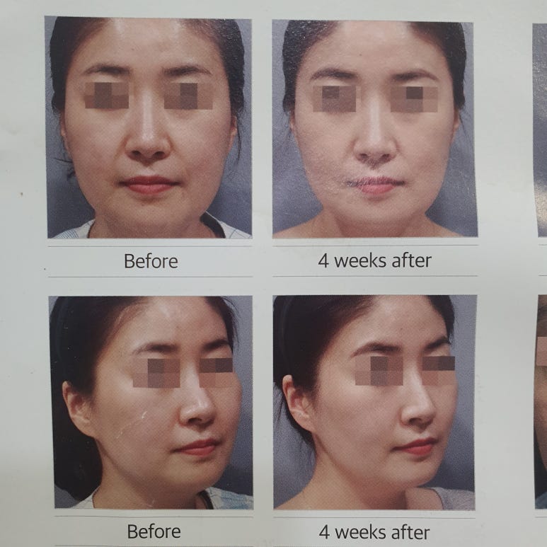[닥터벨뷰 칼럼 35.] 스킨 부스터 VS 콜라겐 부스터 관련 이미지 9