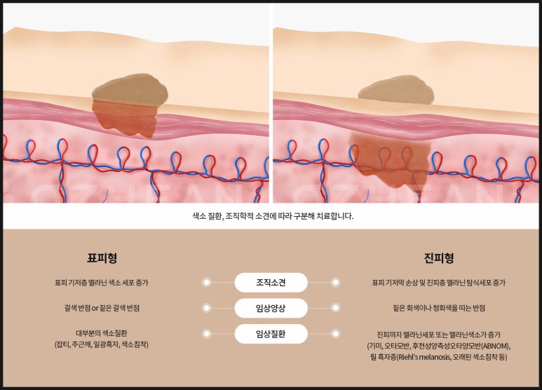 피부과 시술 중 색소는 왜 꼭 초기에 치료하라고 할까? 관련 이미지 4