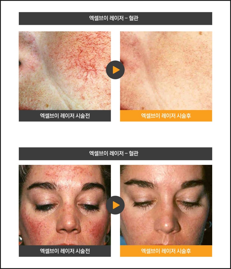 Causes of Vascular Dilation, a Case of Skin Flare-Up and Sensitivity After Facial Paralysis, and Excel V image 7