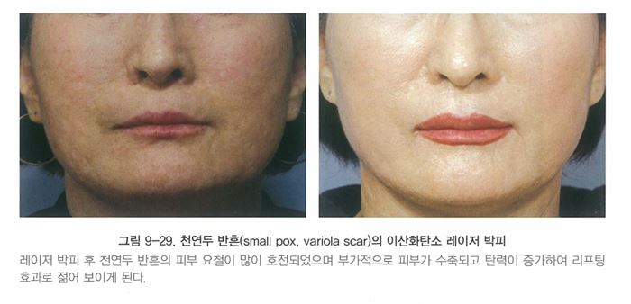 [닥터벨뷰 칼럼 27.] 레이저 후 색소침착과 홍반에 대하여 관련 이미지 7