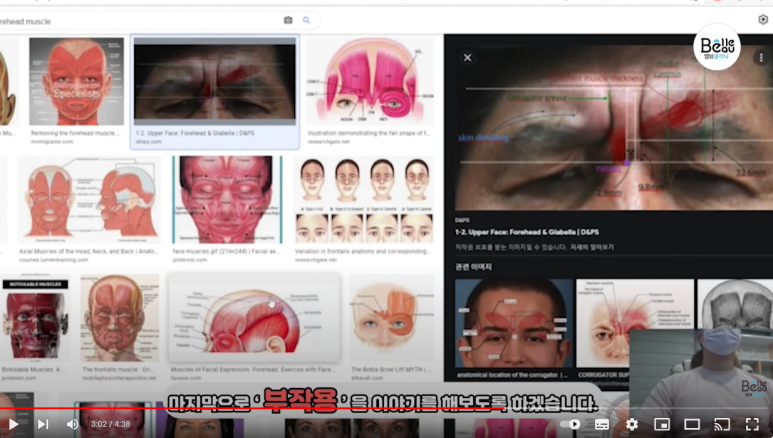 이마 미간 보톡스 이런 분들은 조심하세요 관련 이미지 11