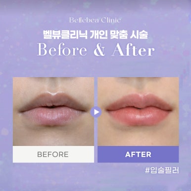 점심시간에 예뻐지는 비법! 벨뷰 퀵 시술 추천 관련 이미지 4