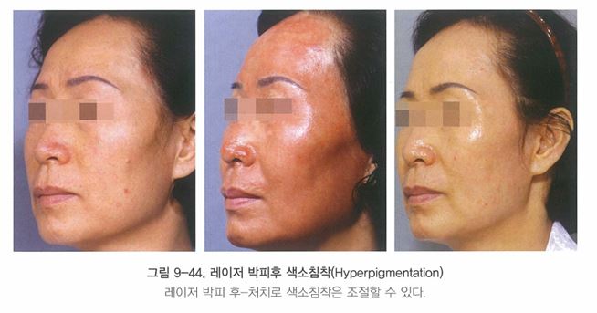 [닥터벨뷰 칼럼 27.] 레이저 후 색소침착과 홍반에 대하여 관련 이미지 2