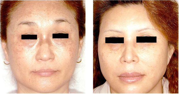 염증 후 과색소 침착(PIH) 어떻게 해결할까 관련 이미지 8