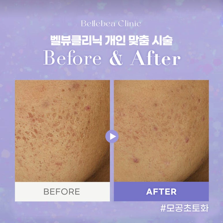 벨뷰클리닉 모공초토화 전후사진 관련 이미지 1