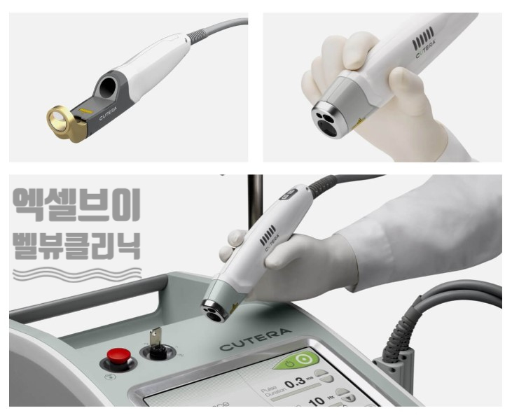 Bellvue Clinic Excel V Laser Treatment A to Z image 1
