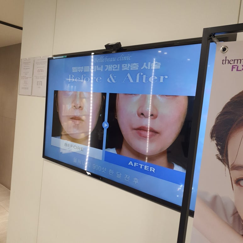 [닥터벨뷰 칼럼 34.] 스킨 보톡스(메조보톡스)와 근육 보톡스의 차이점 관련 이미지 5