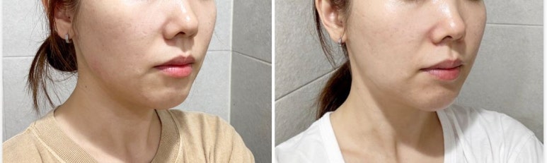 [닥터벨뷰 칼럼 94.] 굴곡진 땅콩형 얼굴, 무조건 당기는 리프팅이 정답이 아닌 이유 관련 이미지 5