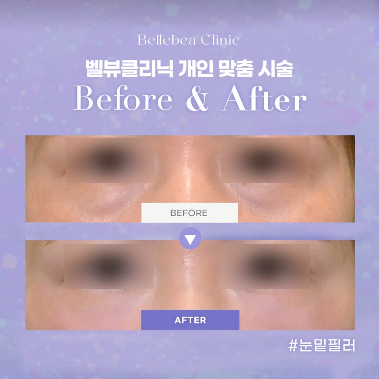 13. 강남역피부과 애교필러전후사진 애교필러후기 관련 이미지 1
