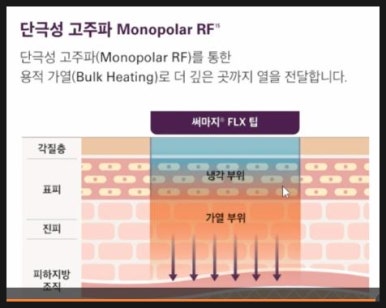 [닥터벨뷰 칼럼 86.]울쎄라(HIFU), 써마지(RF), 그리고 벨뷰에 새로 도입된 온다 리프팅 비교 관련 이미지 6