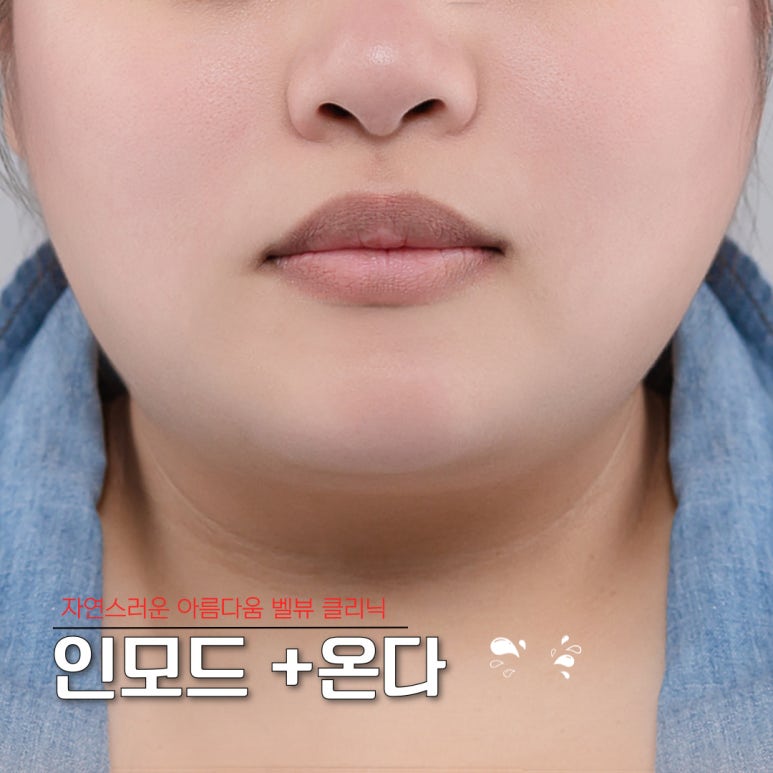 The Battle Between Microwaves and Radiofrequency: How to Choose a Customized Lifting Treatment for Your Face Shape [ONDA vs. InMode] image 3