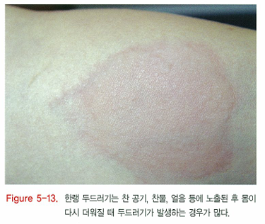 다양한 두드러기 종류 1탄 (알레르기성/ 만성특발성/ 한랭성/ 열성/ 피부묘기증 등) 관련 이미지 10