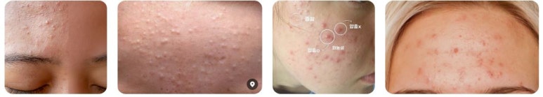 [Dr. Bellview Column 72.] Acne: Don’t Worry Anymore! Causes and Solutions by Type image 6