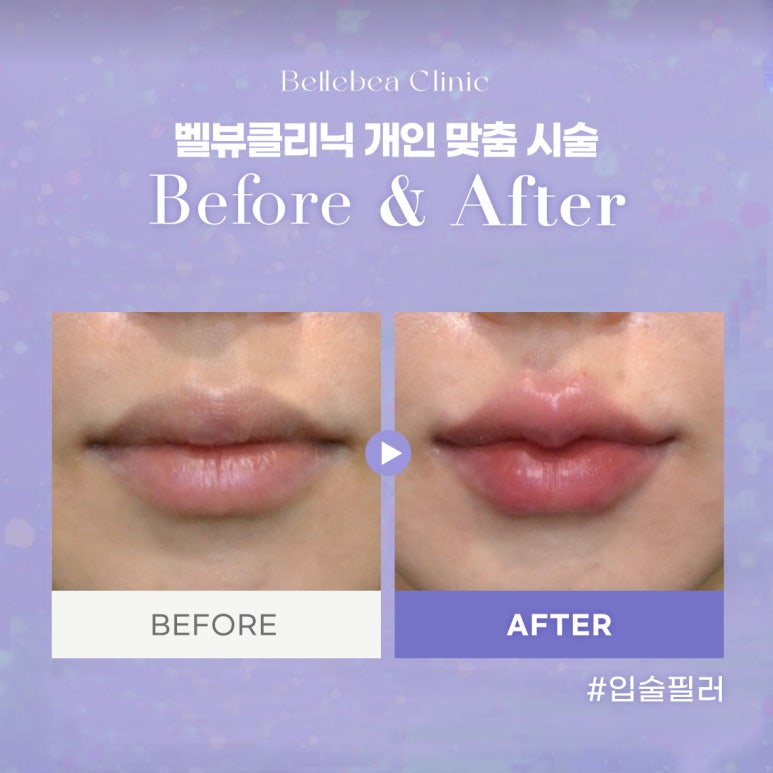 21. 강남역피부과 입술필러전후사진 입술필러후기 관련 이미지 1