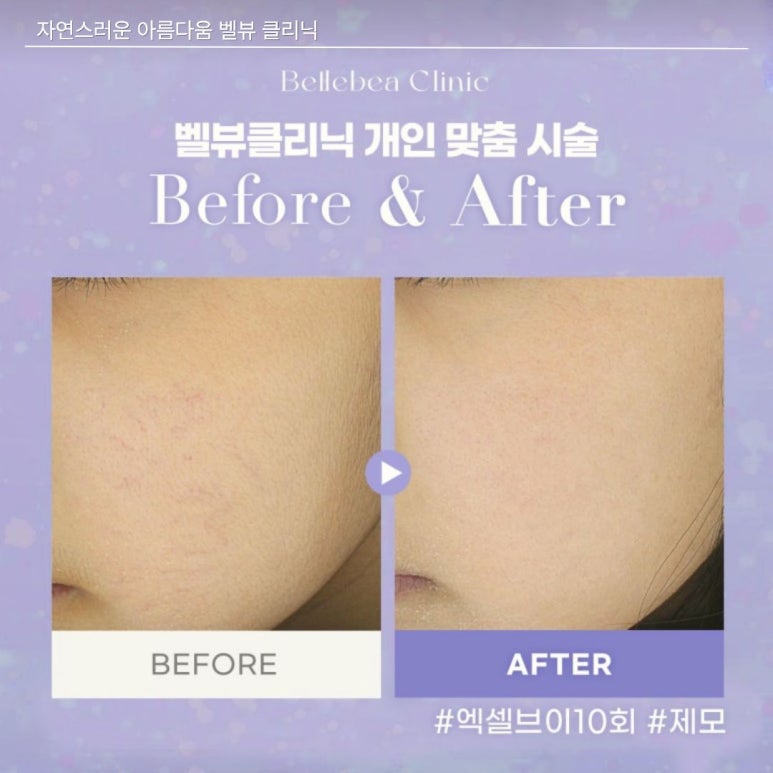 벨뷰의원 엑셀브이 제모 시술 10회 전후 사진 관련 이미지 1