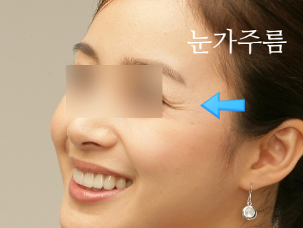 [Dr. Bellevue Column 105.] Crow’s Feet & Under-Eye Wrinkles Have Different Causes, So Why Receive the Same Treatment? (A Complete Comparison of Botox vs. Eye Thermage vs. Rejuran i) image 3