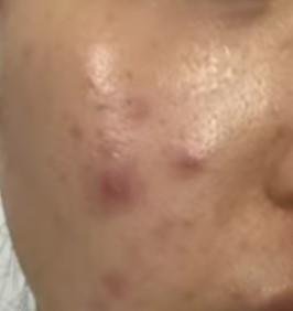 [닥터벨뷰 칼럼 77.] 여드름 색소 침착, 방치하면 관련 이미지 5