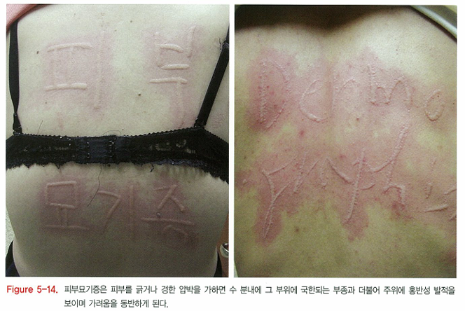 다양한 두드러기 종류 1탄 (알레르기성/ 만성특발성/ 한랭성/ 열성/ 피부묘기증 등) 관련 이미지 11