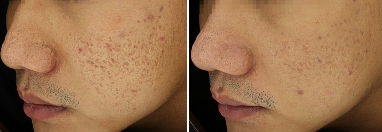 여드름 흉터 모공 해결사 [ 포텐자 + 쥬베룩 ] 관련 이미지 5