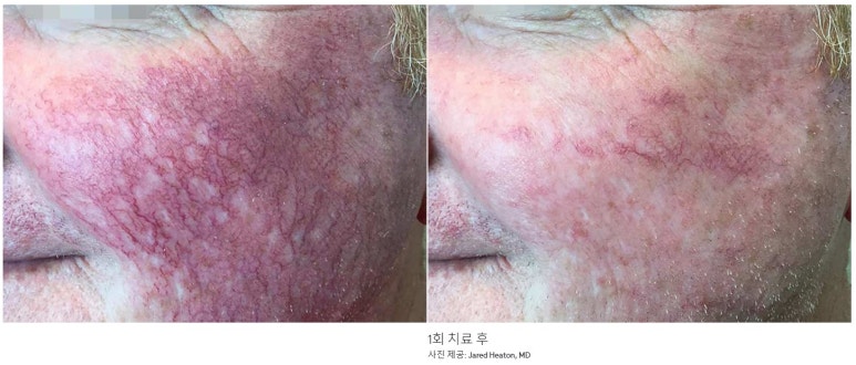 Bellvue Clinic Excel V Laser Treatment A to Z image 13