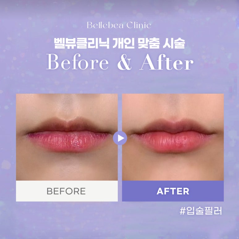 28. 벨뷰클리닉 입술필러 전후사진 관련 이미지 1