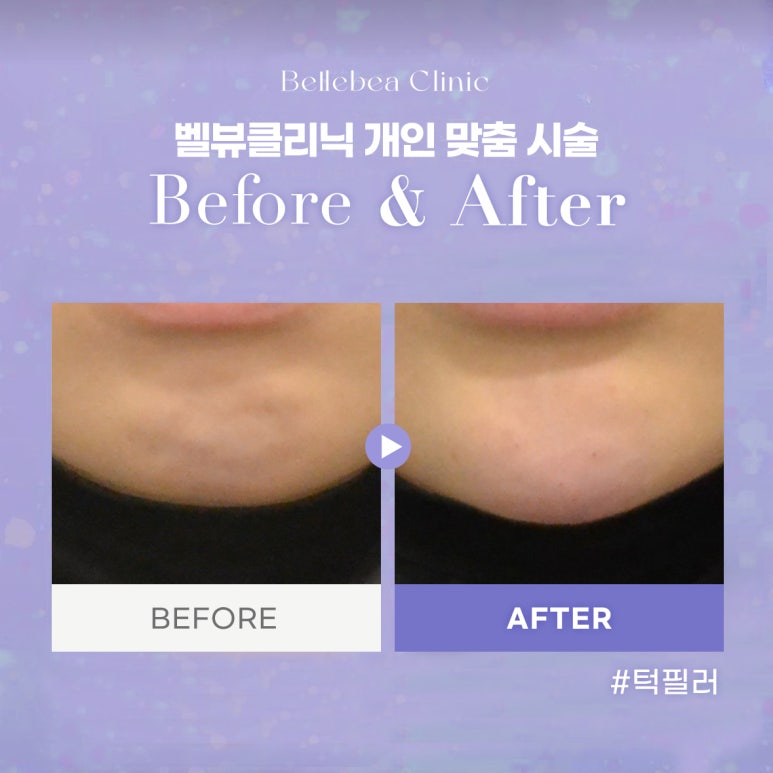 47. 벨뷰클리닉 턱 필러 전후사진 관련 이미지 1