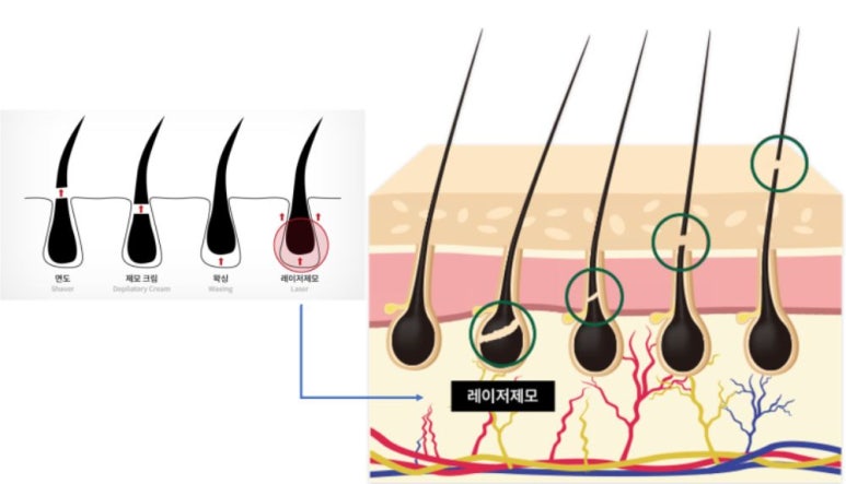 [Dr. Bellevue Column 99.] How to Break Free from Razor Burn and Folliculitis image 4