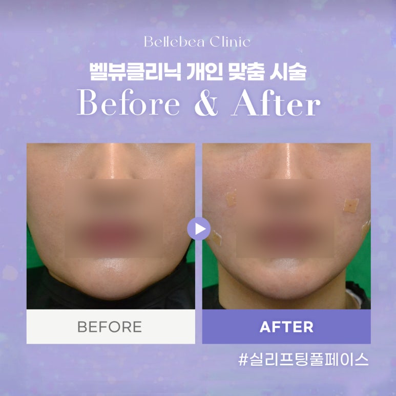 벨뷰클리닉 개인 맞춤 시술 관련 이미지 1