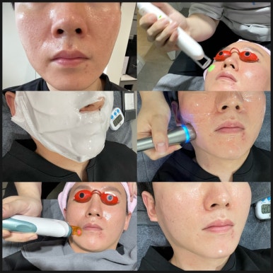 엑셀V 레이저로 실핏줄 혈관없애고 깨끗하고 맑은 피부 톤 찾기 관련 이미지 6