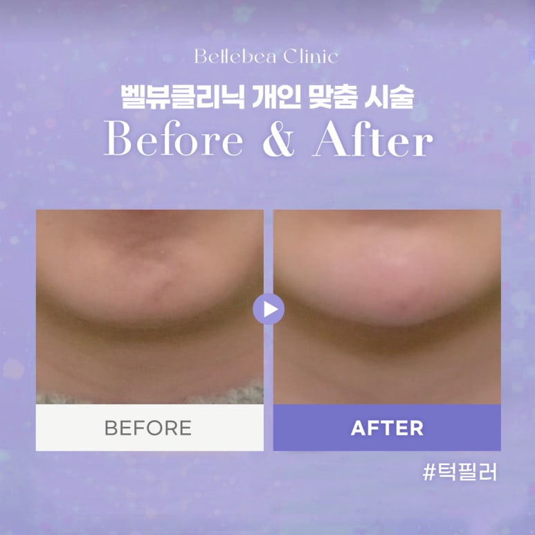 42. 벨뷰클리닉 턱필러 전후사진 관련 이미지 1