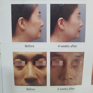 [Dr. Bellview Column 90.] Luxury Skin Completed by a Hair’s Breadth of Difference: Why the Dosage of Skin Boosters Determines the Details of the Result image 5