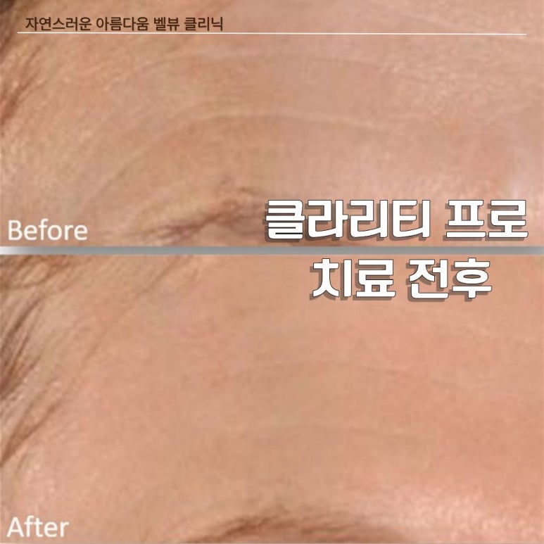 벨뷰 클리닉 클라리티 프로 레이저 치료 A to Z 관련 이미지 7