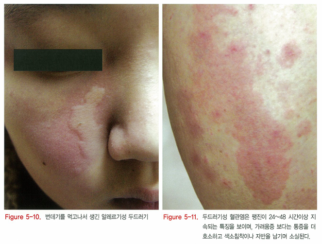 다양한 두드러기 종류 1탄 (알레르기성/ 만성특발성/ 한랭성/ 열성/ 피부묘기증 등) 관련 이미지 8