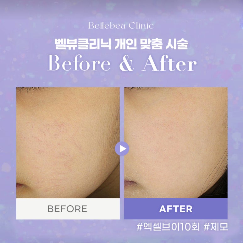 벨뷰클리닉 맞춤시술 엑셀브이 제모 전후 사진 관련 이미지 1
