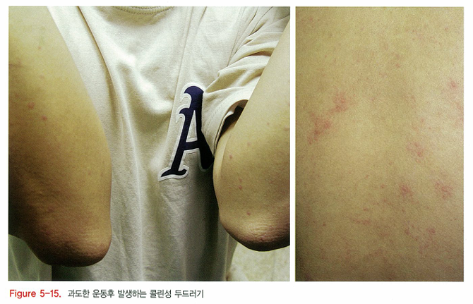 다양한 두드러기 종류 2탄 (진동성, 콜린성, 접촉성, 압박성, 아스피린 불내성, 햇빛 두드러기, 물 두드러기 등) 관련 이미지 5