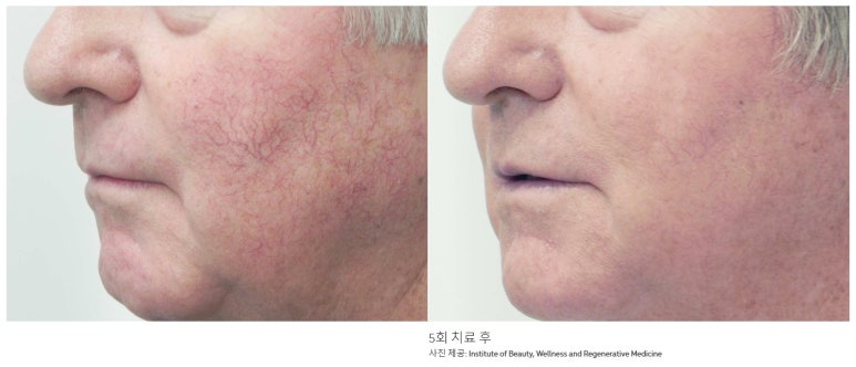 Bellvue Clinic Excel V Laser Treatment A to Z image 16