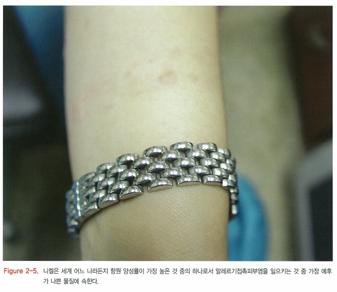 알레르기 접촉 피부염 / 자극 접촉 피부염 관련 이미지 5