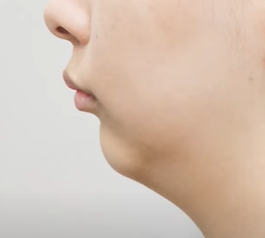 [닥터벨뷰 칼럼 14.] 보기 싫은 이중턱이 생기는 원인 관련 이미지 4