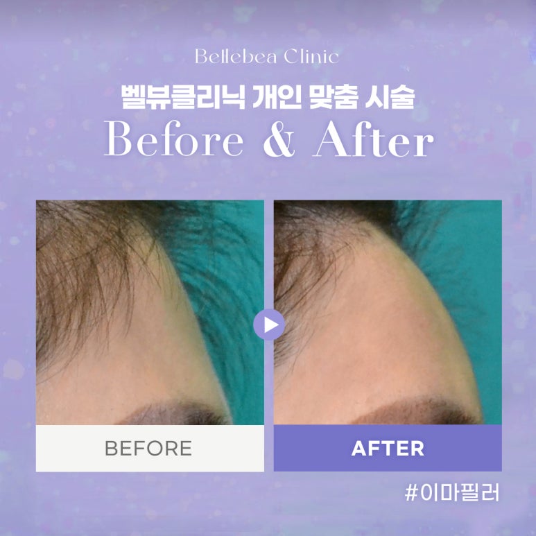 2. 강남역피부과 이마필러전후사진 이마필러후기 관련 이미지 1