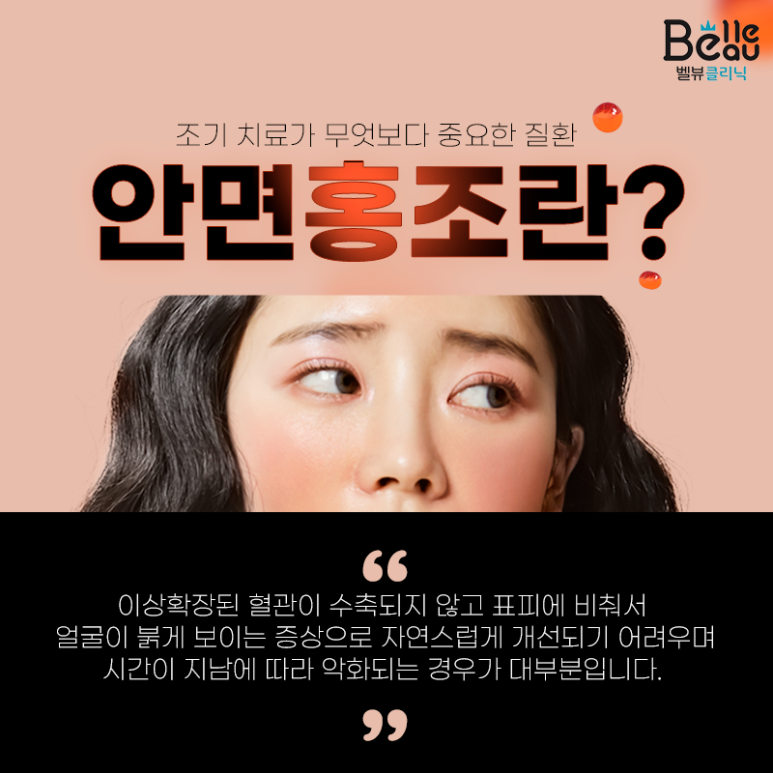 홍조치료 레이저 엑셀v를 이용한 안면홍조 치료와 효과 관련 이미지 1