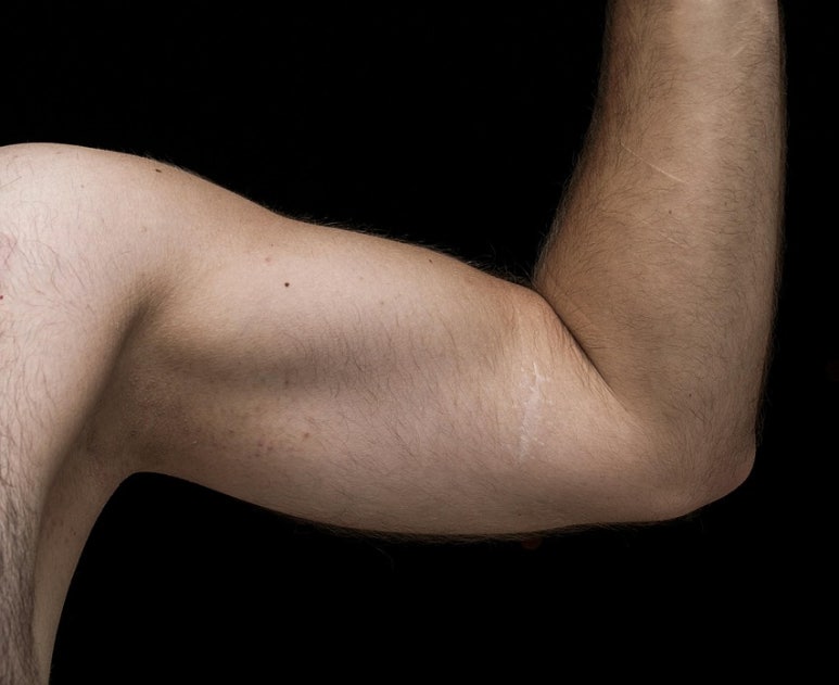 [Dr. Bellview Column 69.] Can Sweat and Odor Be Controlled with Laser Hair Removal? image 5
