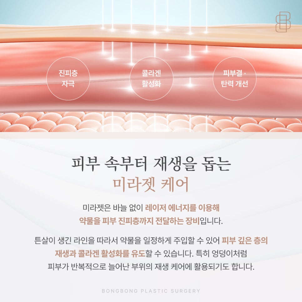 갑자기 찐 살로 생긴 엉덩이 튼살 미라젯으로 매끄러워질 수 있을까? 관련 이미지 4