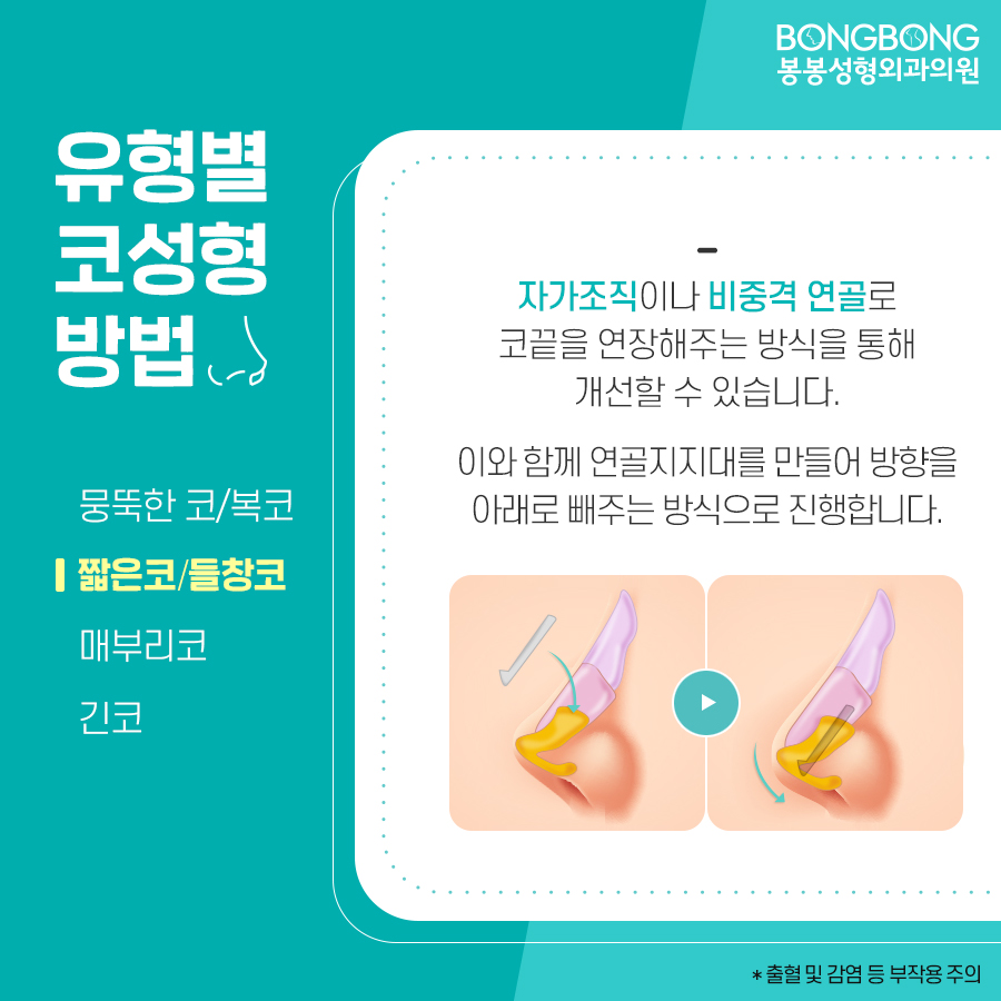 봉봉성형외과에서 설명하는 코성형방법/특징 관련 이미지 5