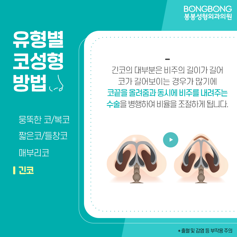 봉봉성형외과에서 설명하는 코성형방법/특징 관련 이미지 7