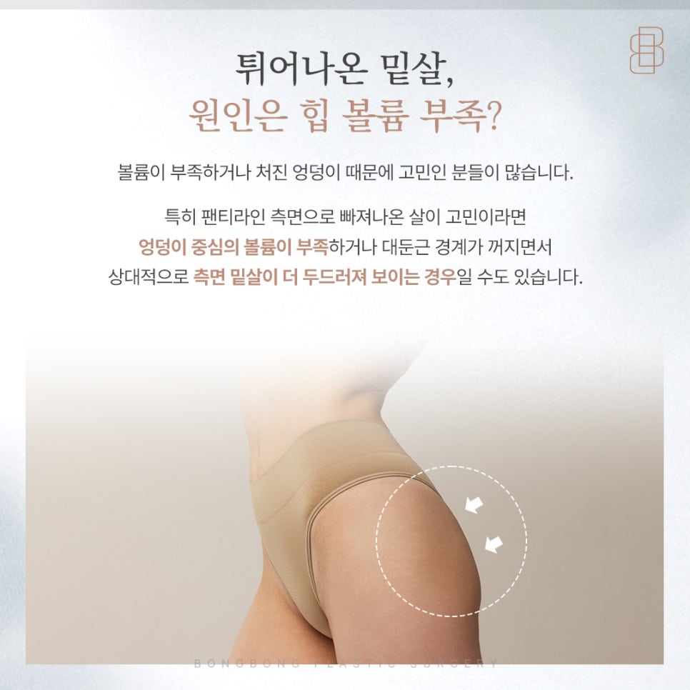 볼륨 부족과 밑살 처짐을 함께 보는 하이브리드 힙업성형 관련 이미지 2