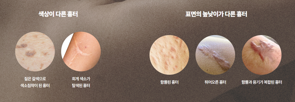 제왕절개부터 성형수술까지, 절개 반흔, 흉터 걱정은! 관련 이미지 3