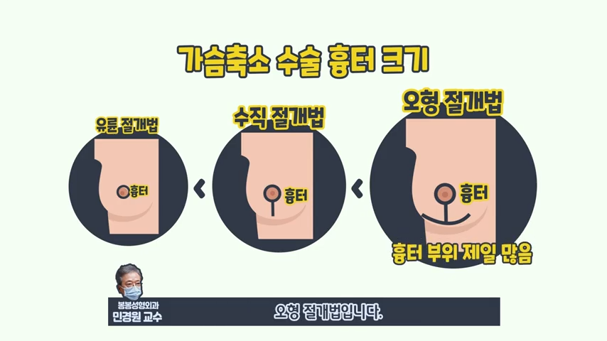 [봉봉성형외과] 가슴축소수술? 절개부위가 많이 큰가요? 관련 이미지 3