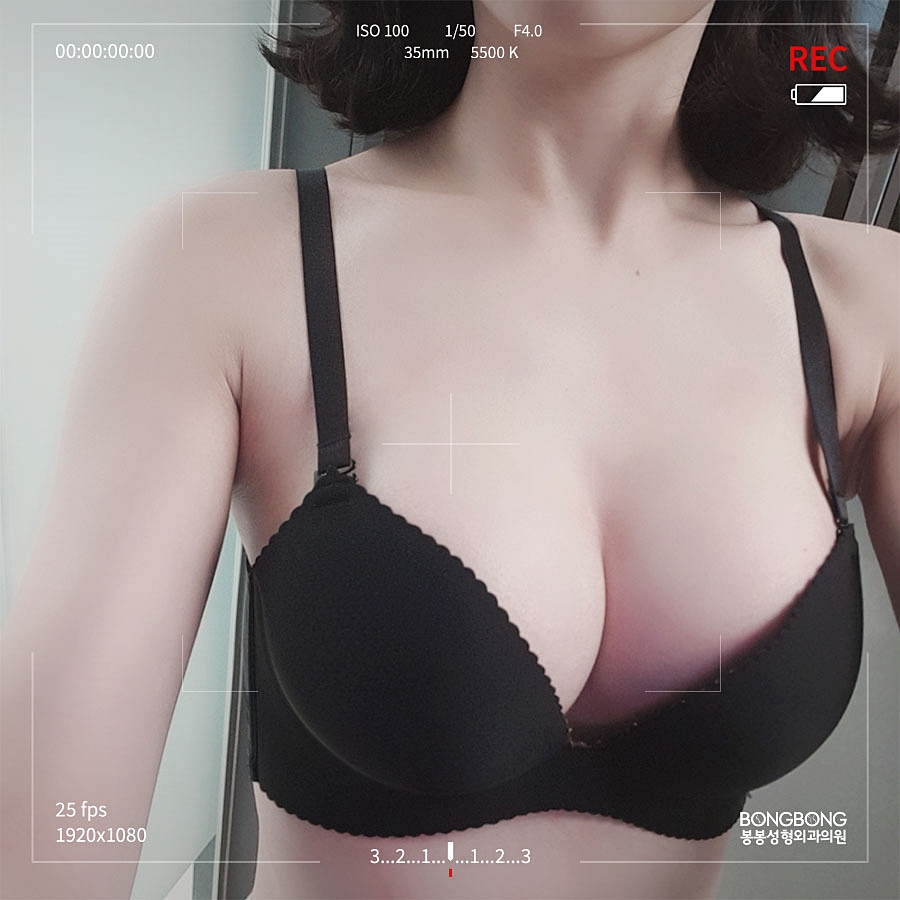 자연스러운 촉감과 모양 살린 가슴수술, 모티바로 정했다! 관련 이미지 1